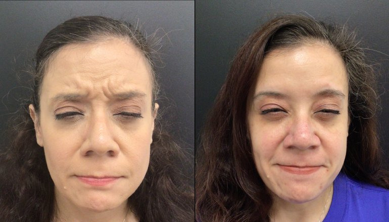 Botox® / Dysport® Case 63 Marge Image