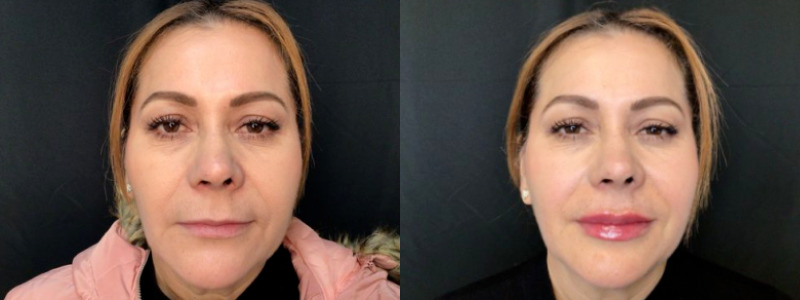 Lip Injections Case 67 Marge Image