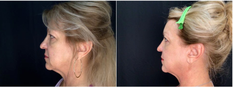 Sofwave™ Case 10 Marge Image