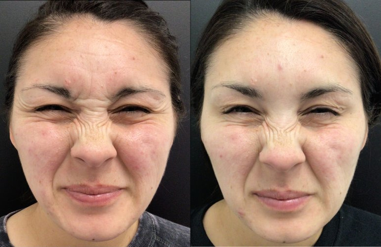 Botox® / Dysport® Case 61 Marge Image