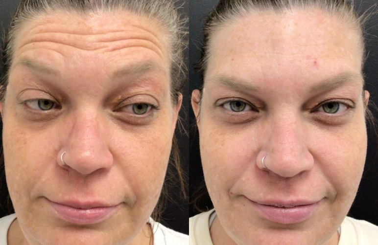 Botox® / Dysport® Case 60 Marge Image