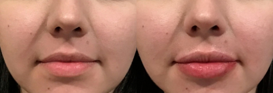 Lip Injections Case 66 Marge Image