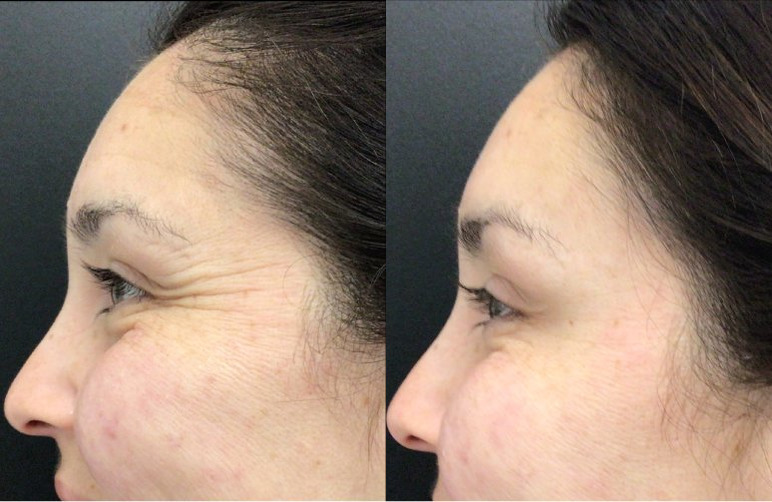 Botox® / Dysport® Case 61 Marge Image