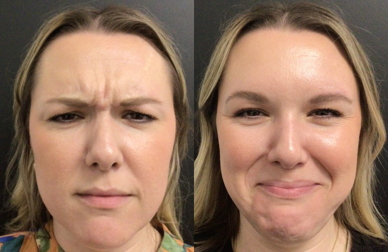 Botox® / Dysport® Case 69 Marge Image