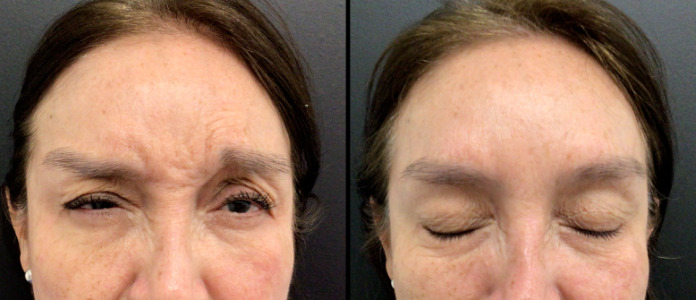 Botox® / Dysport® Case 64 Marge Image