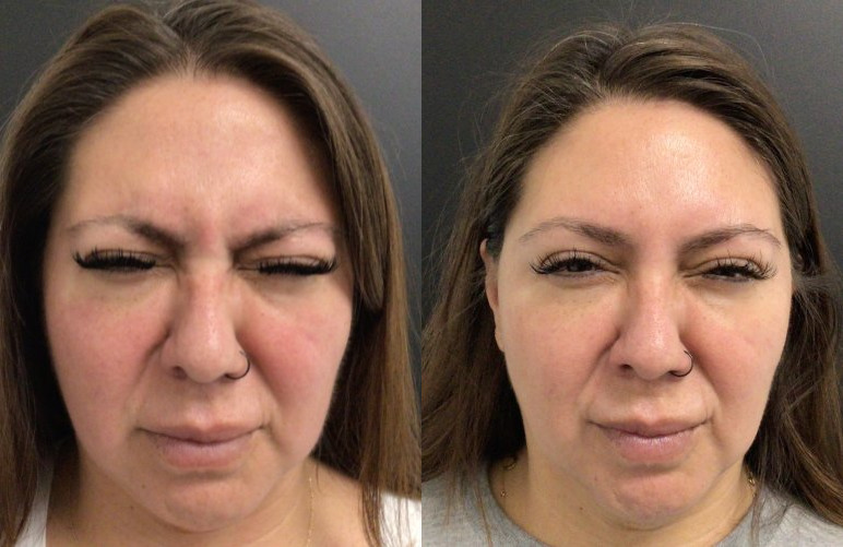 Botox® / Dysport® Case 68 Marge Image