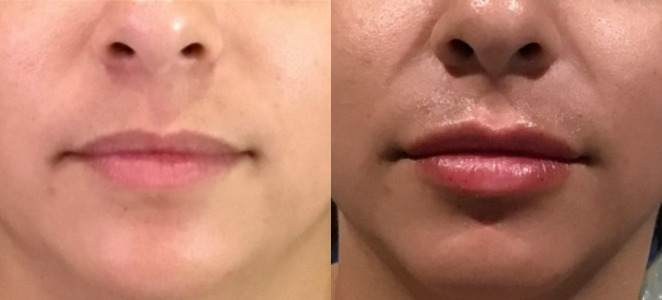 Lip Injections Case 64 Marge Image