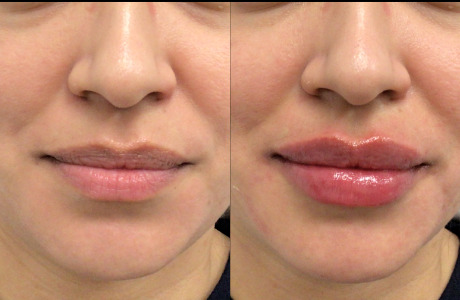 Lip Injections Case 68 Marge Image