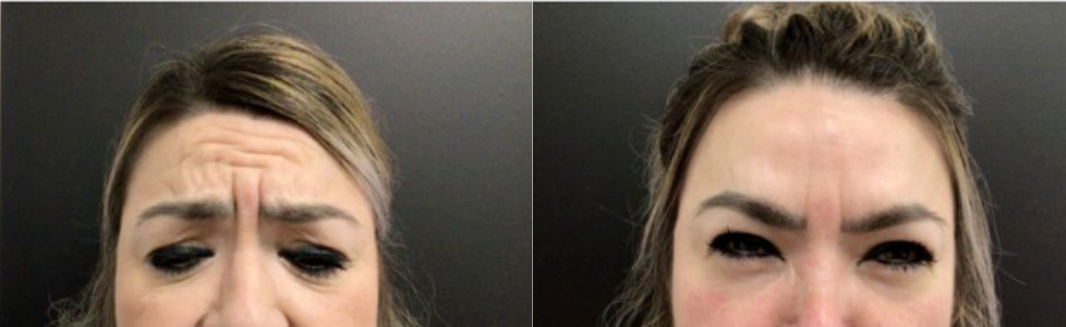 Botox® / Dysport® Case 66 Marge Image