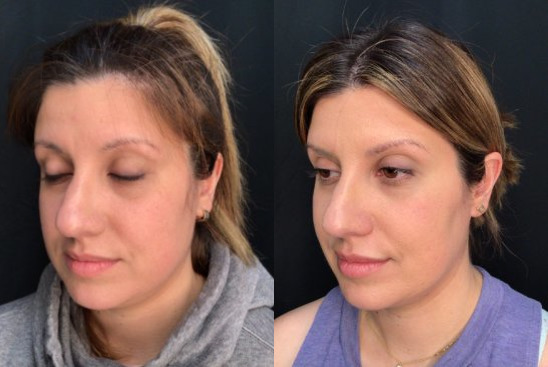 Dermal Fillers Case 77 Marge Image