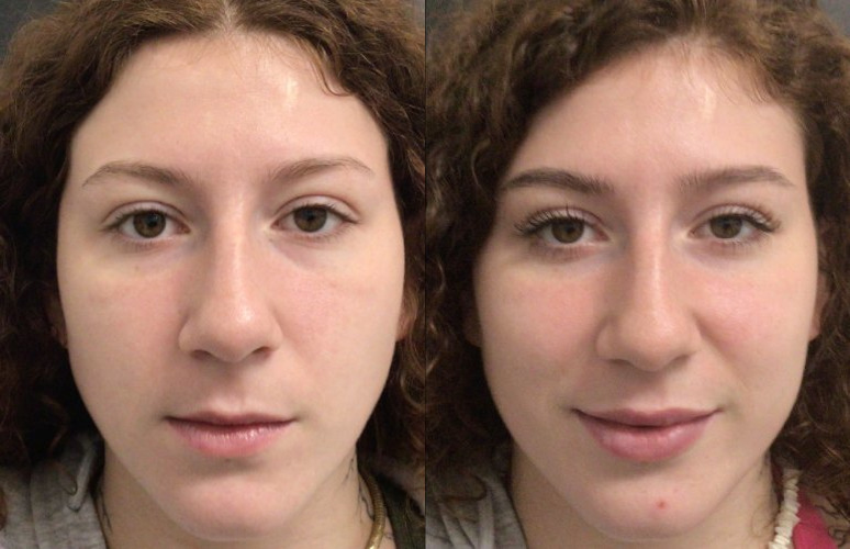 Dermal Fillers Case 78 Marge Image