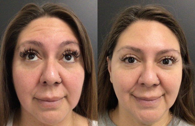 Botox® / Dysport® Case 68 Marge Image