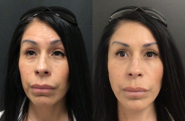 Botox® / Dysport® Case 70 Marge Image