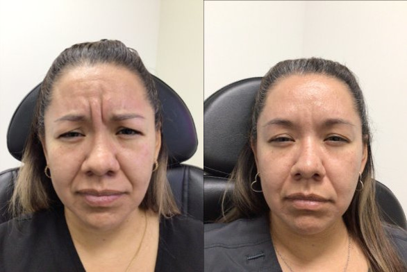 Botox® / Dysport® Case 65 Marge Image