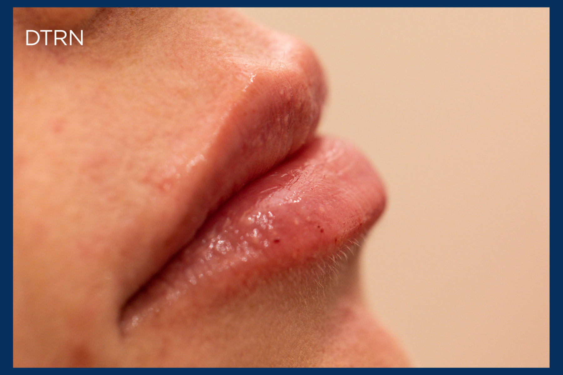 how long does lip filler last blog DermaTouch RN Houston San Antonio