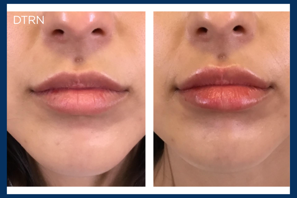 getting lip fillers for the first time