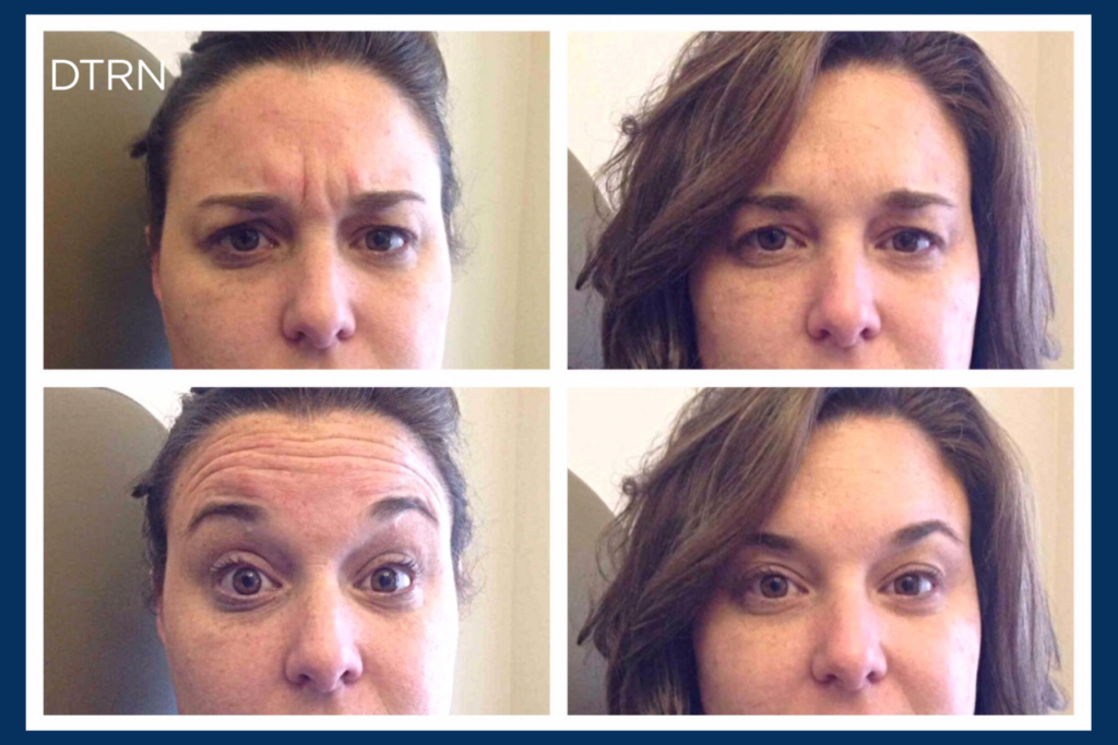 Botox services near me Botox before and after DermaTouch RN Houston San Antonio Texas